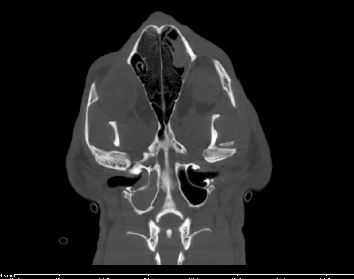 Coronal Plane